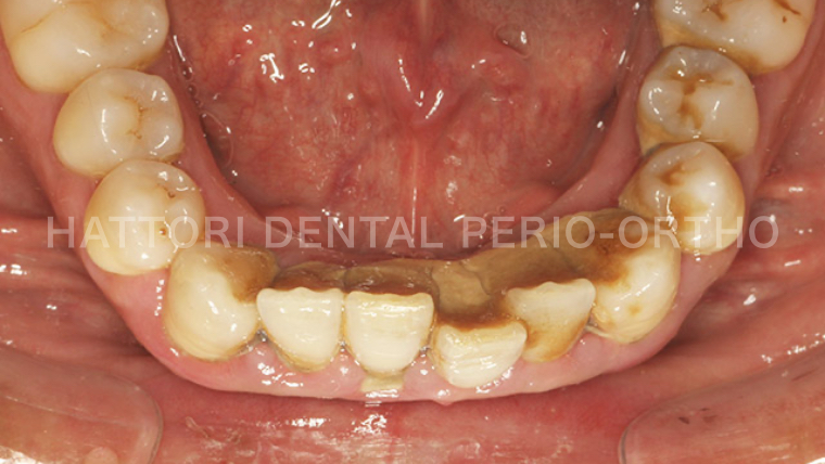 歯石が沈着している様子